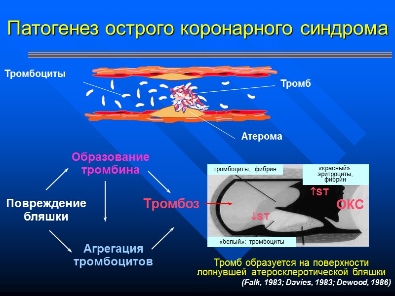 Патогенез острого коронарного синдрома Повреждение бляшки Образование тромбина Агрегация тромбоцитов Тромбоз Тромб Тромбоциты Атерома Патогенез острого коронарного синдрома Повреждение бляшки Образование тромбина Агрегация тромбоцитов Тромбоз Тромб Тромбоциты Атерома